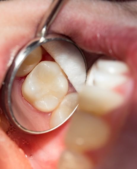 Close up of dental mirror in mouth reflecting a tooth