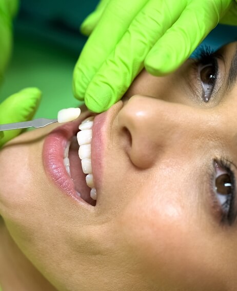 Cosmetic dentist placing a veneer on a patients tooth