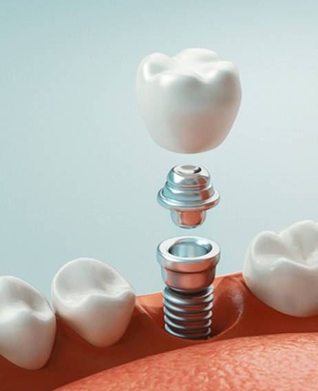 a graphic illustration of an implant-retained dental crown