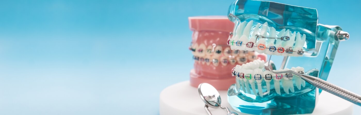 Two models of the teeth with braces