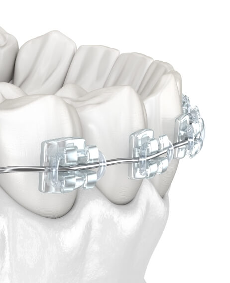 Model of the teeth with braces with clear brackets