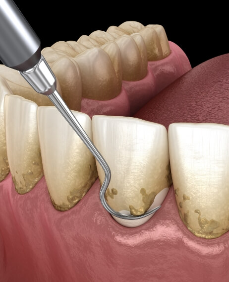 Illustrated dental scaler clearing plaque buildup from teeth during gum disease treatment