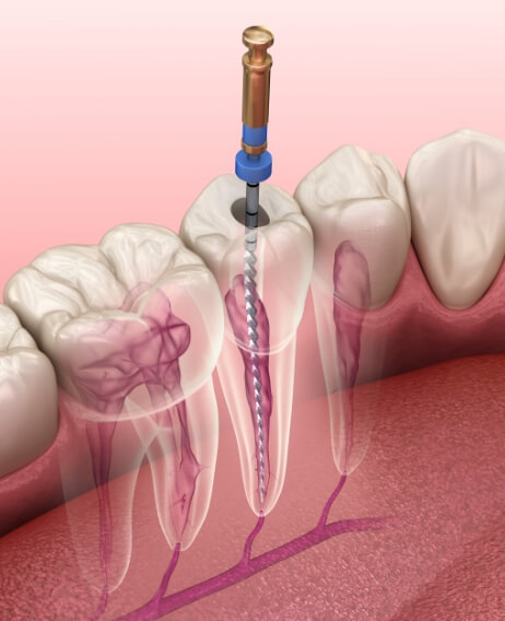 Illustration of thin dental instrument treating the inside of a tooth