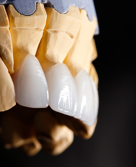 veneers on a plaster mold of a mouth